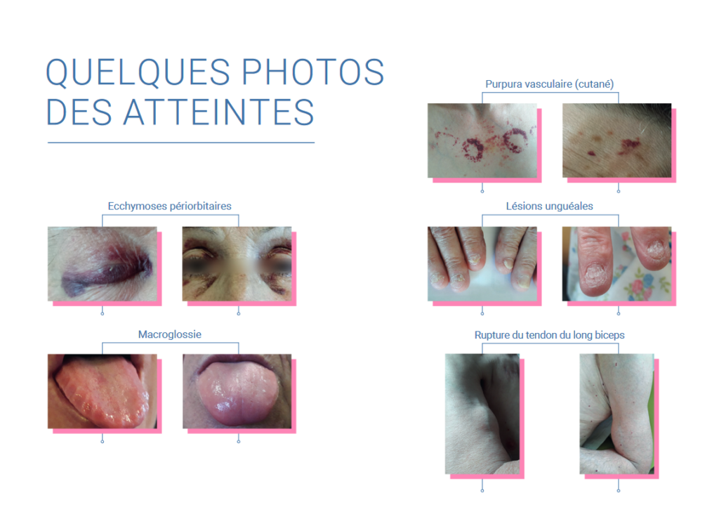 Bloc-Notes-atteintes-réseau-amylose-photos