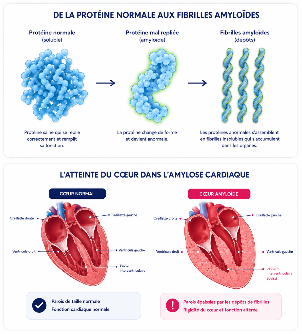 diagnostiquer-neuropathie-amyloide